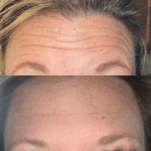 Dysport Eliminates Wrinkles