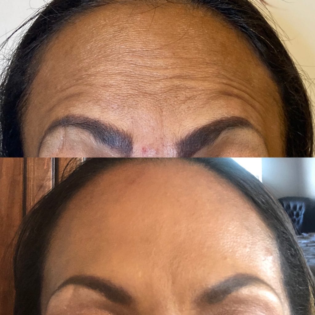 Xeomin: Before and after 