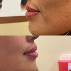 Lip Augmentation